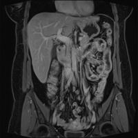 Resonancia nuclear magnetica de abdomen con contraste. 883401. Idime