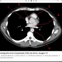 Tomografia axial computada de torax extendido al abdomen superior con suprarrenales.879391 Idime