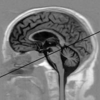 Resonancia nuclear magnetica simple para evaluacion dinámica de líquido cefalorraquídeo. 883107 Idime