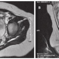 Angiorresonancia de pelvis, CUPS 883909. Idime (2022)