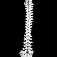 Radiografia de columna vertebral total. 871060 Idime
