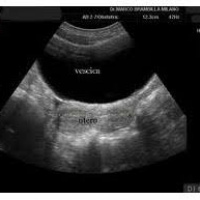 Seguimiento ecografico de ovulacion transvaginal x sesión. Ecografias Bogota (Mandalay)