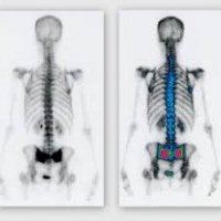 Gamagrafia osea con spect.920903  Idime (2024)