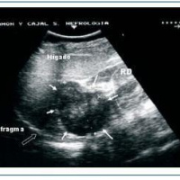 Ecografia doppler de otros organos trasplantados. 882602 Idime