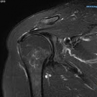 Artrorresonancia de hombro. 878711 Idime