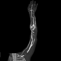 Angiotomografia de miembros superiores.879901  Idime. (2024)