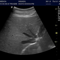 Ecografia de abdomen (masas abdominales y retroperitoneo). 881340 Idime