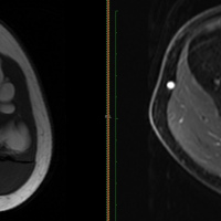 Resonancia nuclear magnetica de miembro superior sin incluir articulaciones con contraste. 88883511. Idime