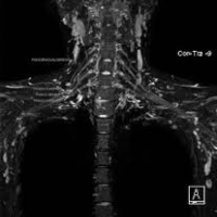 Resonancia nuclear magnetica de plejo braquial con contraste. 883560. Idime