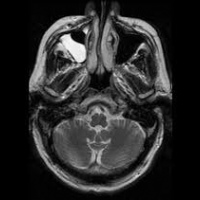 Resonancia nuclear magnetica de senos paranasales o cara con contraste. 883110. Idime