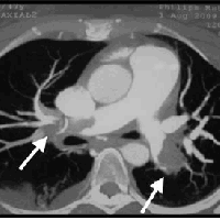 Tomografia computada de vasos. Arterias pulmonares. 879901   Idime (2024)