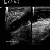 Ecografia articular de rodilla. 881620 Idime