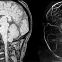 Resonancia nuclear magnetica con angiografia cerebral con contraste.883909  Idime