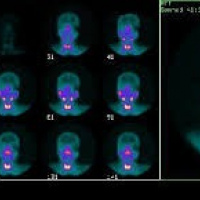 Gamagrafia de glandulas salivales. 920601  Idime (2024)
