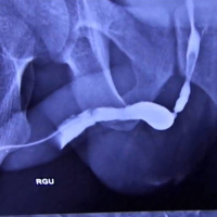 Uretrografia retrograda. 877871 Idime