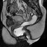 Resonancia nuclear magnetica dinamica de piso pelvico.883441 Idime