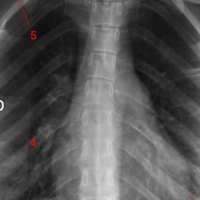 Radiografia de columna toracica. 871020  Idime