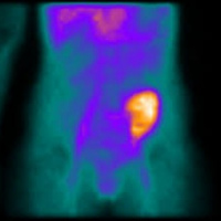 Gamagrafia de trasplante renal.920813  Idime (2024)