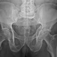 Radiografia de cadera comparativa.(adulto o niño) 873412 Idime