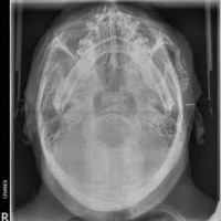 Radiografia de arco cigomatico.870105 Idime