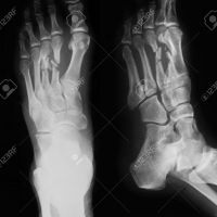 Radiografia de pie AP y lateral. 873333Idime