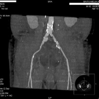 Tomografia computada de vasos. De cadera. 879901  Idime (2024)