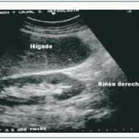 Ecografia doppler de riñon trasplantado a color. 882603 Idime