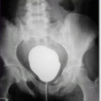 Cistografia con proyecciones oblicuas. 877851 Idime