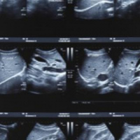 Ecografia de tejidos blandos de abdomen con analisis doppler. 881362  Idime