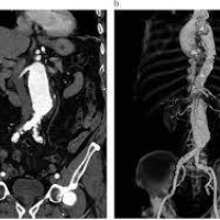 Angiotomografia de aorta toracica. 879901. Idime (2022)