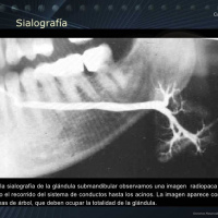 Sialografia (por glandula). 874700  Idime