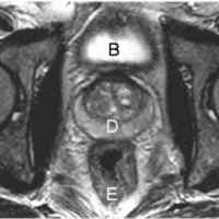 Resonancia nuclear magnetica de prostata. Codigo CUPS 883902 Idime