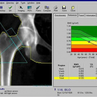 Osteodensitometria por absorcion dual. 886012 Idime