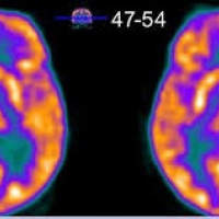 Gamagrafia metabolica cerebral con 18 FDG (PET-CT). 920106 Idime (2024)