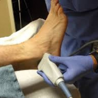 Ultrasonografia articular de tobillo. 881621. Idime