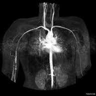 Angiorresonancia de miembro superior con contraste. CUPS 883909. Idime (2022)