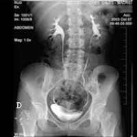 Urografia intravenosa.877802 Idime