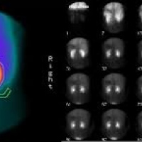 Gamagrafia renal estatica con unidosis DMSA. 920809  Idime (2024)