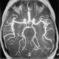 Resonancia nuclear magnetica con angiografia cerebral simple. 883909 Idime