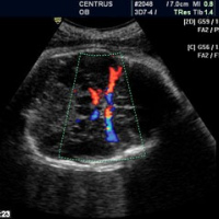 Doppler obstetrico circulacion placentaria - uterina. 882298 Idime
