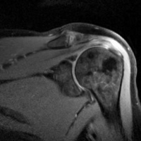 Resonancia nuclear magnetica de articulacion de miembro superior con contraste (codo, hombro o puño). 883512. Idime