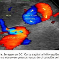 Ecografia doppler con evaluacion de flujo sanguineo en hipertension portal. 882296 Idime