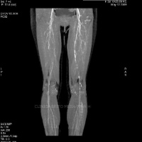 Tomografia axial computada de miembros inferiores y articulaciones. 879520 Idime