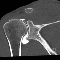 Artrotac de hombro. 99902869. Idime. (2022)