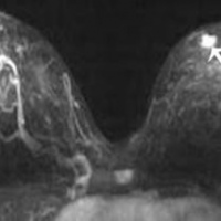 Resonancia nuclear magnetica de mama 883351. Idime (2022)