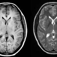 Resonancia nuclear magnetica de cerebro con contraste. 883101. Idime