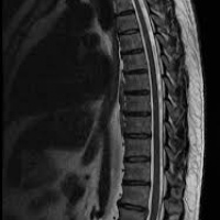 Resonancia nuclear magnetica de columna toracica con contraste. 883220. Idime