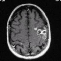 Resonancia magnetica de cerebro. EN. Codigo CUPS 883101 (2022)