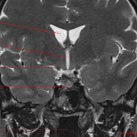 Resonancia nuclear magnetica de base de craneo silla turca con contraste. 883102. Idime