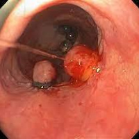 Ligadura várices esofágicas. Uniendoscopia (2023)